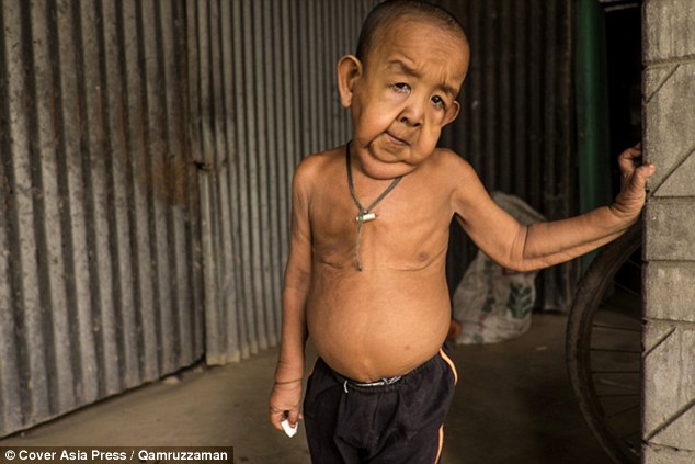 Bayezid Hossain este un baietel de patru ani din Bangladesh, care arata ca un batran de 80 de ani. El sufera de progeria, o afectiune foarte rara.