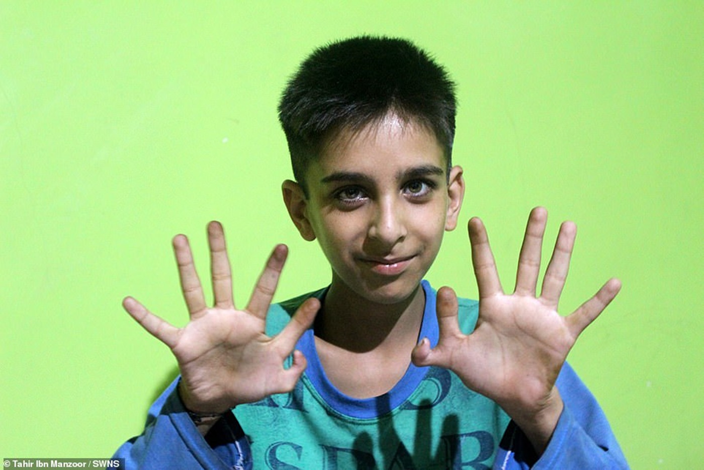 Povestea băiatului care s-a născut cu 12 degete la mâini! Părinții nu vor să îl opereze