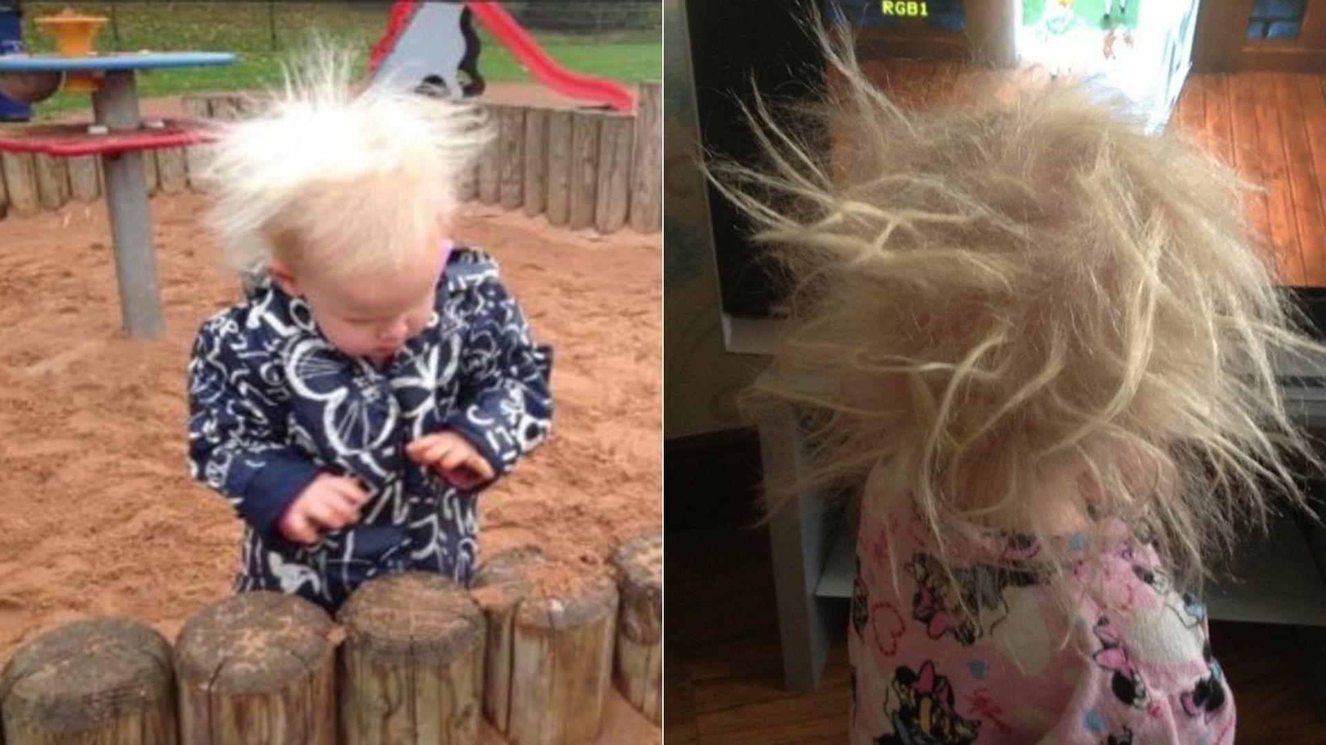Cum arată fetița cu părul ca vata de zahăr căreia medicii i-au interzis să-și perie podoaba capilară. Suferă de un sindrom rar